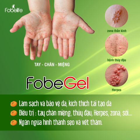 Gel Tái Tạo Da Fobe Chống Virus - Hỗ Trợ Làm Lành Da Thủy Đậu, Tay-Chân-Miệng, Côn Trùng Cắn 30g