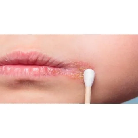 Gel tróc mép Herpes SOS Lippenherpes Hàn Đức - Giảm đau, ngứa nhanh chóng, làm khô và lành vết thương hiệu quả