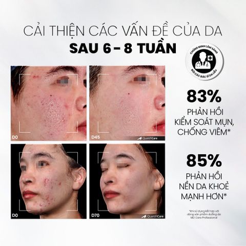 MD CARE Sữa Rửa Mặt BHA Dạng Bọt - Giảm Nhờn, Ngăn Ngừa Mụn, Làm Sạch Lỗ Chân Lông, Dưỡng Ẩm Cho Da Dầu & Nhạy Cảm (200ml)