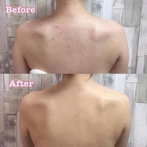 Sữa Tắm A-DERMA Eco Hydra Protecteur 500ml - Giảm Mụn Lưng, Thu Nhỏ Lỗ Chân Lông, Dưỡng Ẩm Tự Nhiên, Phù Hợp Cho Da Nhạy Cảm