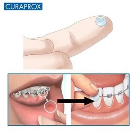 Sáp nha khoa Gum Ortho Wax + Vitamin E cho răng niềng 1 vỉ (USA)