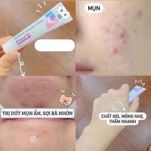 Kem giảm mụn Klenzit C & MS - Giải pháp hiệu quả cho mụn ẩn, mụn bọc và thâm nám, làm sáng da từ Ấn Độ