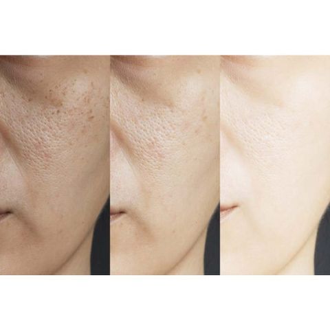 Tinh Chất Se Khít Lỗ Chân Lông DIEGO DALLA PALMA - Serum Giảm Dầu, Ngừa Mụn và Dưỡng Ẩm Mịn Da Cho Da Dầu và Hỗn Hợp