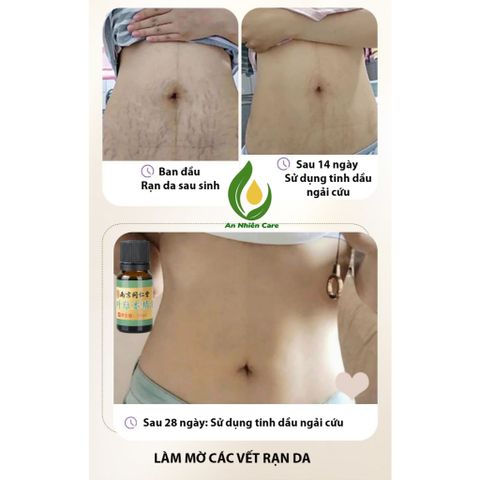 Tinh Dầu Ngải Cứu & Gừng - Chăm Sóc Da, Giảm Đau Đầu, Giúp Ngủ Sâu, Dưỡng Ẩm Tự Nhiên, Hỗ Trợ Làm Mờ Vết Rạn Da