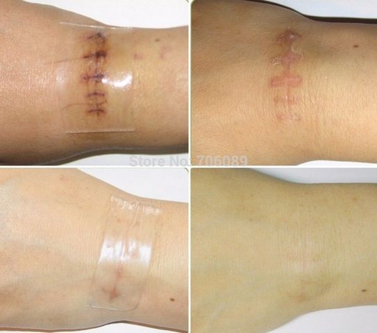 Tấm Dán Xoá Mờ Sẹo Lồi Scar FX - Sản Phẩm Hỗ Trợ Khắc Phục Sẹo Chất Lượng Mỹ, Dễ Dàng Sử Dụng, Hiệu Quả Rõ Rệt