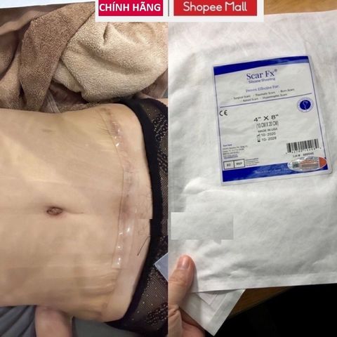 Tấm Dán Xoá Mờ Sẹo Lồi Scar FX - Sản Phẩm Hỗ Trợ Khắc Phục Sẹo Chất Lượng Mỹ, Dễ Dàng Sử Dụng, Hiệu Quả Rõ Rệt