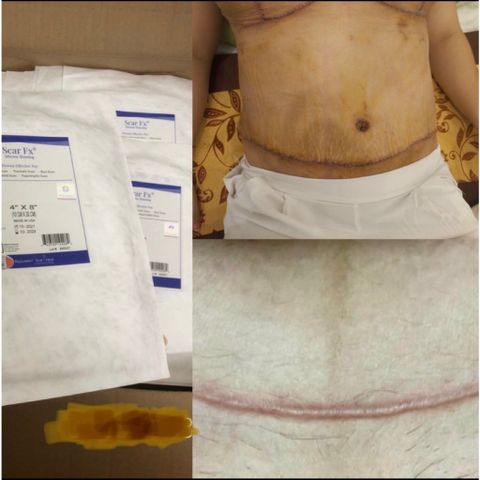 Tấm Dán Xoá Mờ Sẹo Lồi Scar FX - Sản Phẩm Hỗ Trợ Khắc Phục Sẹo Chất Lượng Mỹ, Dễ Dàng Sử Dụng, Hiệu Quả Rõ Rệt