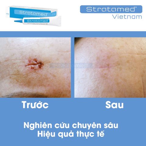 Combo Gel Silicone Strataderm & Stratamed cho vết thương hở, hỗ trợ ngăn ngừa sẹo xấu, làm mềm và phẳng vết sẹo, hiệu quả cao.