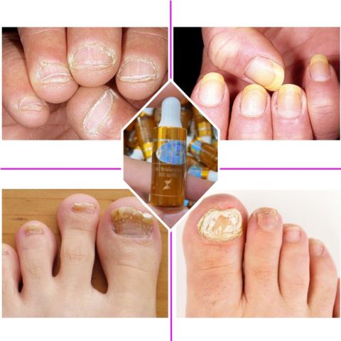 Serum Dưỡng Cứng Móng Phục Hồi Nấm Móng & Hư Khóe - Giải Pháp Cho Móng Yếu, Hư Tổn, 4ml
