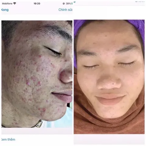 Serum Giảm Mụn Thâm 5 Trong 1 - Hiệu Quả Sau 7 Ngày, Cấp Ẩm, Phục Hồi Da Từ Thành Phần Thiên Nhiên, An Toàn Cho Da Nhạy Cảm