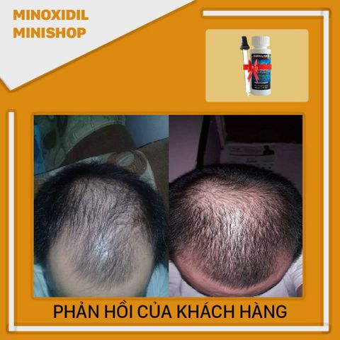 Dung Dịch Minoxidil 5% Mọc Râu Tóc Mỹ - Giải Pháp Tăng Cường Tóc Râu Hiệu Quả, Hỗ Trợ Mọc Tóc Tự Nhiên