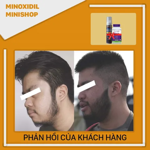 Mino 5% Foam Mọc Râu Tóc với Biotin B7 10,000mcg - Sản phẩm chăm sóc râu và tóc hiệu quả từ Mỹ