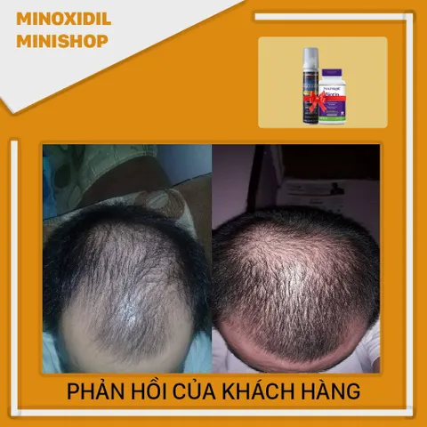 Mino 5% Foam Mọc Râu Tóc với Biotin B7 10,000mcg - Sản phẩm chăm sóc râu và tóc hiệu quả từ Mỹ