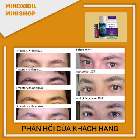 Combo Dung Dịch Mọc Lông Mày Mi Nox Idil 5% - Bao Gồm Castor Oil và Biotin 10,000mcg - Hỗ Trợ Làm Đẹp Tóc và Lông Mày
