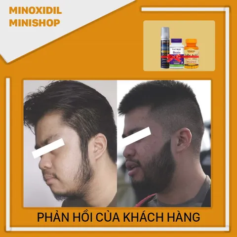 Dung Dịch Mọc Râu Tóc Kirkland 5% Minoxidil Dạng Bọt - Vitamin Biotin & Folic, Giúp Tóc Chắc Khỏe, Dinh Dưỡng Từ Mỹ