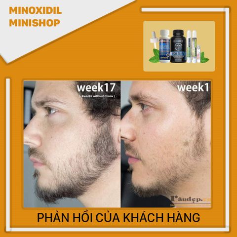 Combo Dung Dịch Mọc Râu Tóc Minoxidil 5% + Iron Beard + LCLT + Retinol - Tăng Cường Mọc Tóc Nhanh Chóng Từ USA