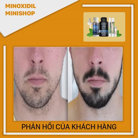 Combo Dung Dịch Mọc Râu Tóc Minoxidil 5% + Iron Beard + LCLT + Retinol - Tăng Cường Mọc Tóc Nhanh Chóng Từ USA