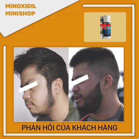 Dung dịch Minoxidil 5% Dạng Lỏng Kích Thích Mọc Râu Tóc Nhanh - Hỗ Trợ Phát Triển Lông Mày, Sản Phẩm Mỹ Kirkland