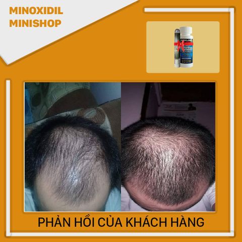 Dung dịch Minoxidil 5% Dạng Lỏng Kích Thích Mọc Râu Tóc Nhanh - Hỗ Trợ Phát Triển Lông Mày, Sản Phẩm Mỹ Kirkland
