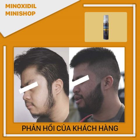 Dung Dịch Mọc Râu Tóc Minoxidil 5% Dạng Bọt - Giúp Mọc Râu Tơ Nhanh Chóng Sau 6-8 Tuần, Sản Phẩm Chính Hãng Từ Mỹ