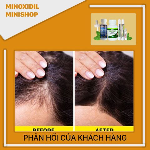 Dung Dịch Mọc Tóc Combo Nâng Cao - Minoxidil 5% + DHT Blocker Ấn Độ, LCLT, Retinol, Peo Mix Tăng Cường Tóc Mọc