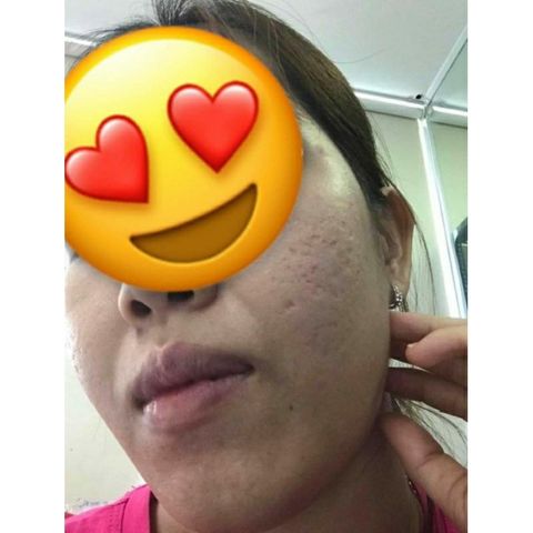 Peel da T.C.AGE Innoaesthetics - Exfo dành cho da lỗ chân lông to , da sẹo lõm 5ml/ lọ