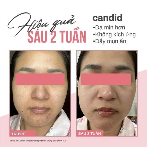 Tinh Chất Dưỡng Da Candid Retinol 0.5% Retinol/ 1% Retinol 30ml