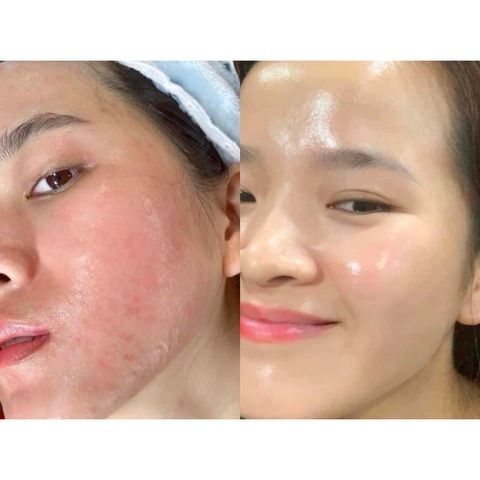 Huyết Tương Plasma Evenswiss Regenerating 10ml