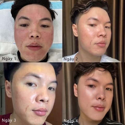 Huyết Tương Plasma Evenswiss Regenerating 10ml