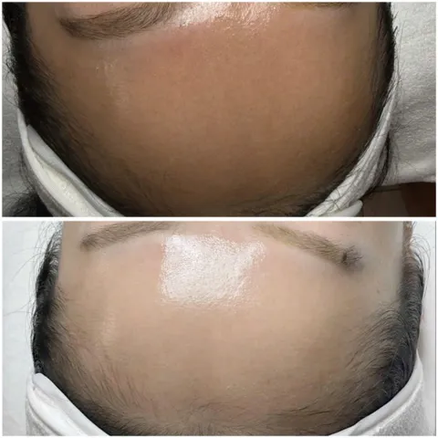 Max White Peel Mesotechl 5ml –  Dưỡng trắng da, làm sáng và tái tạo làn da căng mịn.