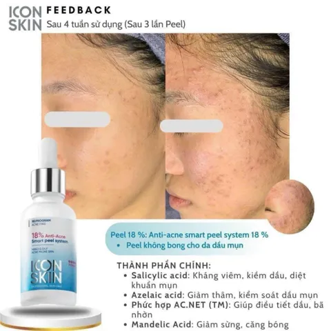ICON SKIN Peel da 18% Anti-acne Smart Peel không bong 30ml