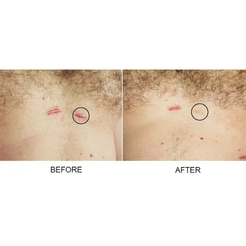 Gel Xóa Sẹo Strataderm Strapharma Thụy Sĩ - Giảm Sẹo Lồi, Sẹo Phì Đại, Chăm Sóc Da, Hiệu Quả Nhanh, An Toàn Cho Mọi Loại Sẹo