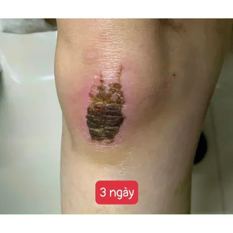 Kem Strataderm Xóa Mờ Sẹo Thâm, Sẹo Rỗ & Sẹo Lõm – Gel Chăm Sóc Da Nhập Khẩu Thụy Sĩ, Giảm Ngứa, Cải Thiện Sẹo Trên Mọi Bề Mặt Da
