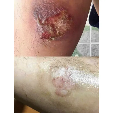 Kem Strataderm Xóa Mờ Sẹo Thâm, Sẹo Rỗ & Sẹo Lõm – Gel Chăm Sóc Da Nhập Khẩu Thụy Sĩ, Giảm Ngứa, Cải Thiện Sẹo Trên Mọi Bề Mặt Da