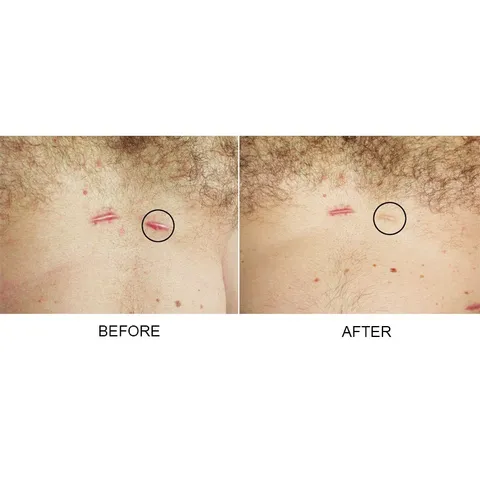 Gel Xóa Sẹo Strataderm 10g - Điều Trị Sẹo Lồi, Sẹo Rỗ, Sẹo Thâm Nhập Khẩu Thụy Sĩ - Giải Pháp Tốt Nhất Cho Làn Da Bạn