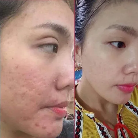 Gel Xóa Sẹo Strataderm 10g - Điều Trị Sẹo Lồi, Sẹo Rỗ, Sẹo Thâm Nhập Khẩu Thụy Sĩ - Giải Pháp Tốt Nhất Cho Làn Da Bạn