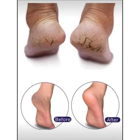 Kem Dưỡng Gót Chân Scholl Schrunden Salbe 25% Urea – Hỗ Trợ Chăm Sóc Da Chân Khô