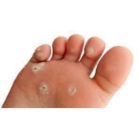 Dung Dịch Chữa Vết Chai Chân DOR NWARZEN-EX 10ml - Giải Pháp Hiệu Quả Chăm Sóc Cá Nhân Hàng Đức