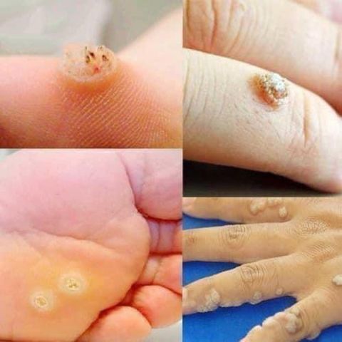 Dung Dịch Chữa Vết Chai Chân DOR NWARZEN-EX 10ml - Giải Pháp Hiệu Quả Chăm Sóc Cá Nhân Hàng Đức