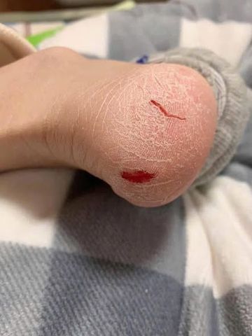 Thanh Lăn Mềm Gót Phục Hồi Gót Chân Nứt Nẻ Rire Heel Care Foot Stick - Chăm Sóc Gót Chân Hiệu Quả, Dễ Sử Dụng