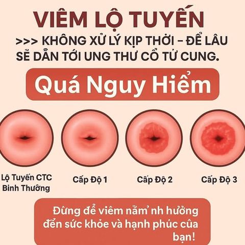 Viên Đặt Phụ Khoa Mycohydralin 500mg - Giúp Cân Bằng pH, Ngăn Ngừa Nhiễm Khuẩn và Viêm Nhiễm, Duy Trì Sức Khỏe Vùng Kín Nữ