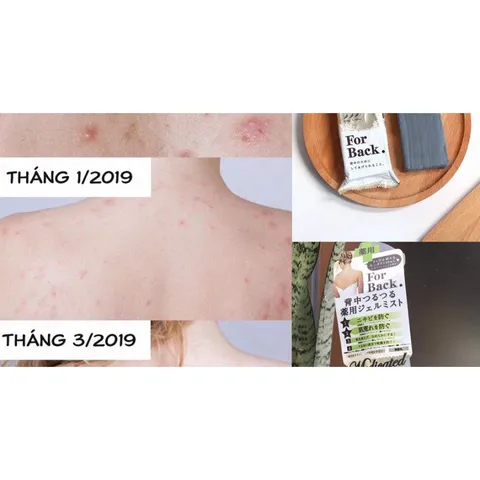 Kem Dưỡng Da Pelican Giảm Mụn Lưng 100ml - Sản Phẩm Chăm Sóc Da Chính Hãng Nhật Bản, Dưỡng Sáng Da và Ngăn Ngừa Thâm Mụn