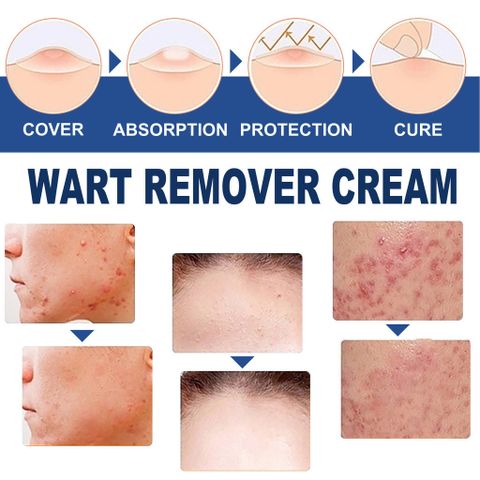 Kem Bôi Rụng Mụn Thịt Thừa & Mụn Cóc 20g - Giải Pháp Làm Sạch Da Tự Nhiên Không Kích Ứng, An Toàn cho Mọi Loại Da