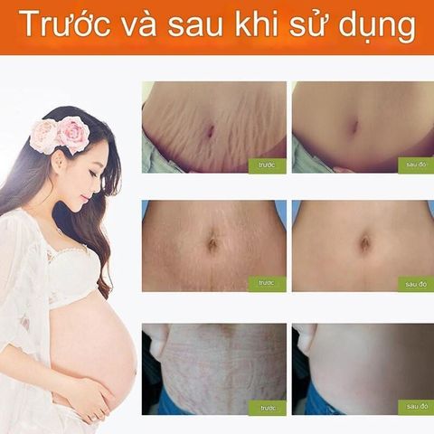 Kem Dưỡng Da 40g - Chống Rạn Da, Dưỡng Ẩm, Làm Sáng Da, Tăng Độ Săn Chắc - Sản Phẩm Chăm Sóc Da Tự Nhiên