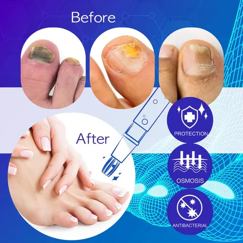 [Hàng nội địa Mỹ] Serum bôi nấm móng tay, chân dạng bút Neomen của Mỹ