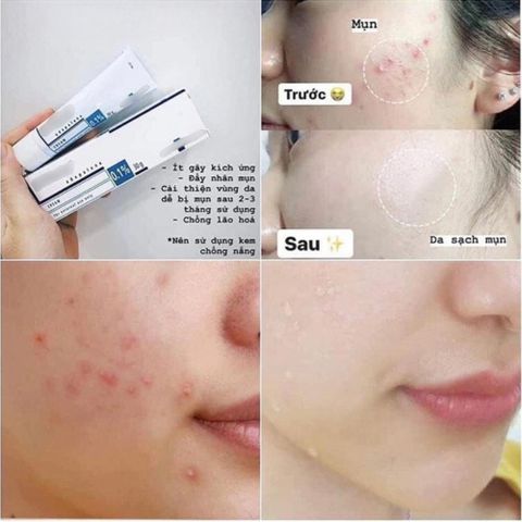 Kem Làm Giảm Mụn Galderma Differ 0.1% 30g – Hỗ Trợ Làm Giảm Mụn Trứng Cá 387757
