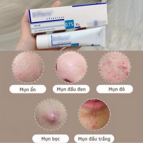 Kem Làm Giảm Mụn Galderma Differ 0.1% 30g – Hỗ Trợ Làm Giảm Mụn Trứng Cá 387757