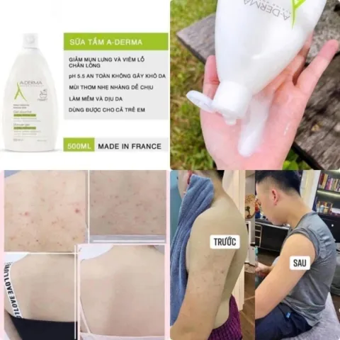 Sữa Tắm A-Derma 500ml – Làm Dịu Da, Ngăn Mụn Lưng & Thu Nhỏ Lỗ Chân Lông 387868