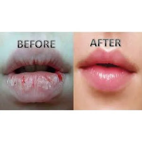 Son Dưỡng Môi Omi Menturm Nhật Bản – Chống Khô Nứt Nẻ, Dưỡng Ẩm, Mềm Môi