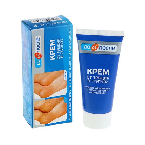 Kem Nứt Gót Chân KPem Nga 50ml – Làm Mềm Da, Giảm Nứt Nẻ, Dưỡng Ẩm Sâu, Phục Hồi Gót Chân Khô Ráp 388358